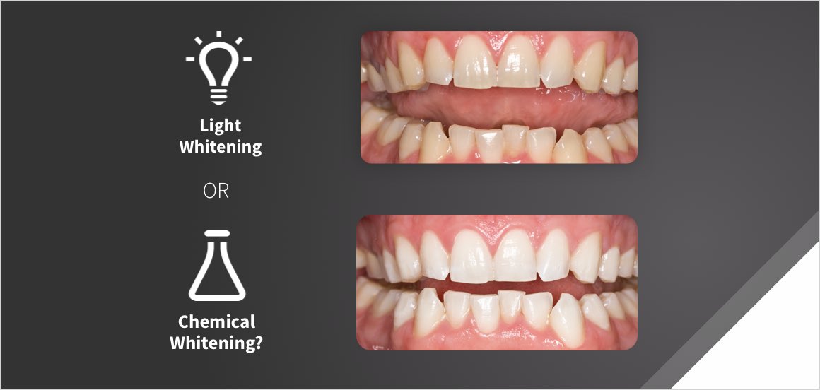 Light VS No Light in Teeth Whitening