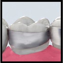 MLR Band Std Contoured Reg ME U Rt 1Molar 32+