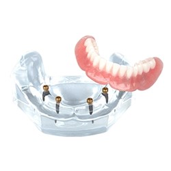 LOC Overdenture Implant Model