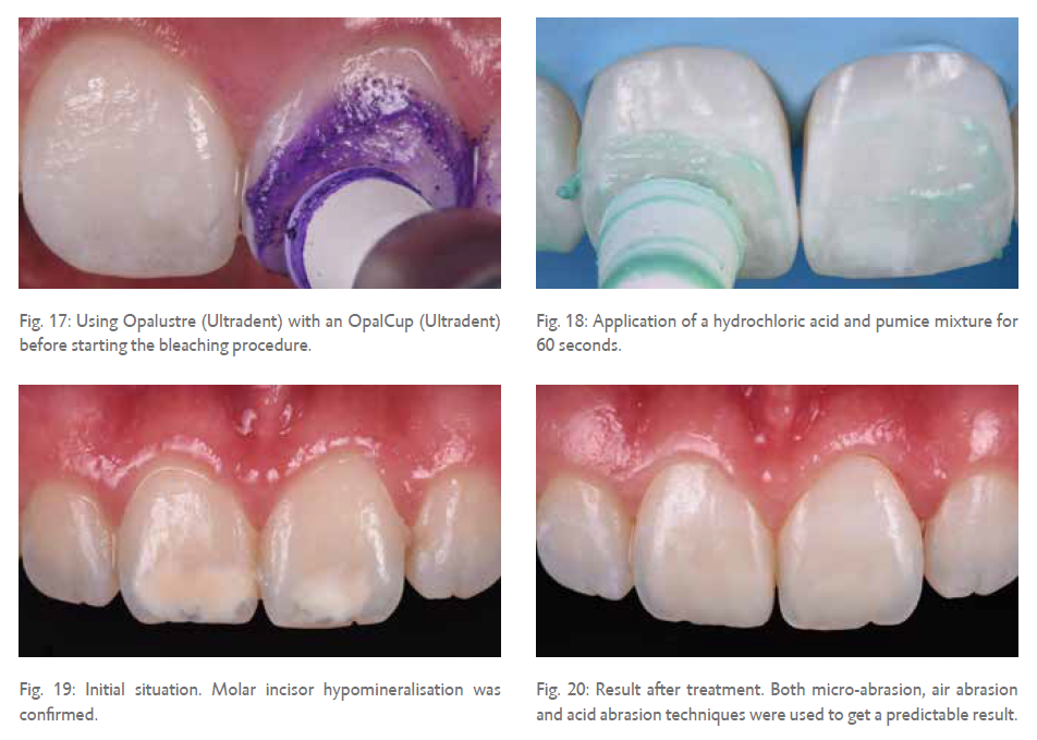 Icon Vestibular: Comparing Different Abrasive Methods for the ...
