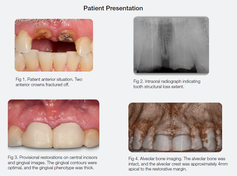 Tapered Pro Conical Anterior Teeth Replacement | Case Study - Henry ...